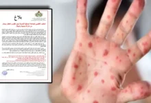 Sindicato Advierte sobre la Propagación de "Bohmaroun" entre los Niños en la Provincia de Al-Madiq Al-Fannidq